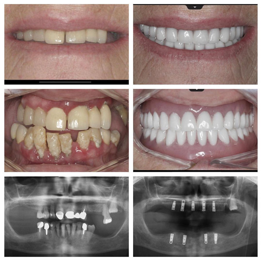 Smile Bright Periodontics Multiple Dental Implant Placement