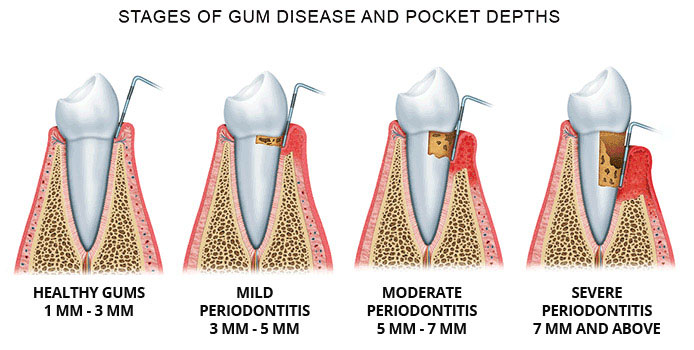 What is dental scaling and root planing?