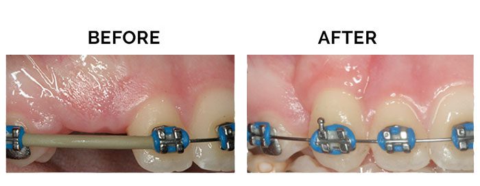 Braces adjustment before and after comparison.