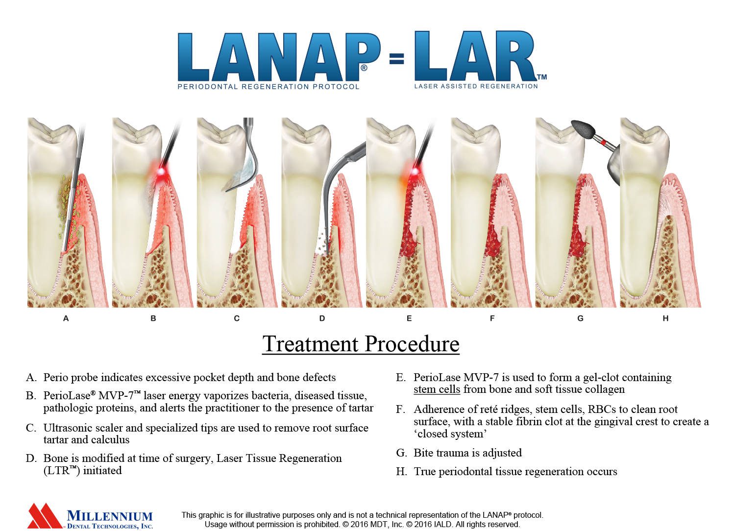 Dental laser treatment procedure illustration steps.